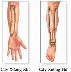 Lưu ý khi phục hồi chức năng sau gãy xương- Ảnh 3.